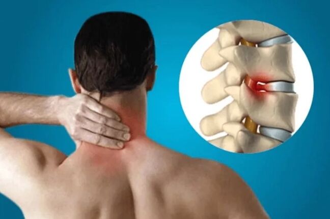 Osteocondrosis de la columna