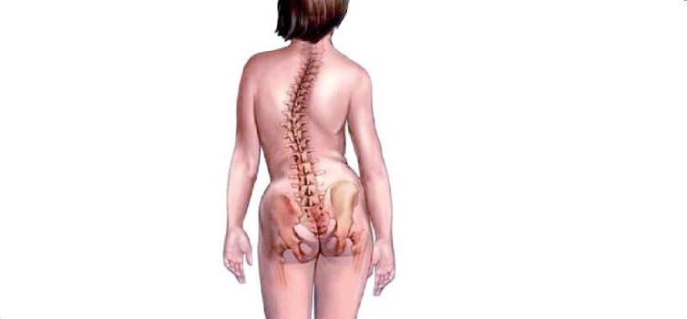osteocondrosis