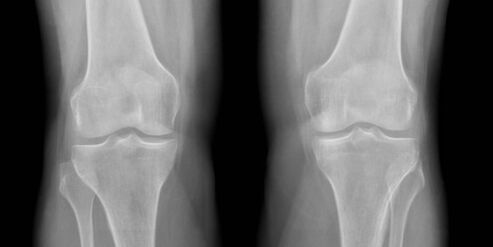 artrosis de rodilla en radiografía