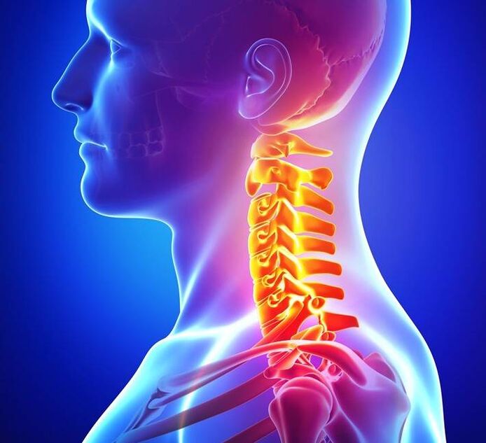 Osteocondrosis de la columna cervical. 