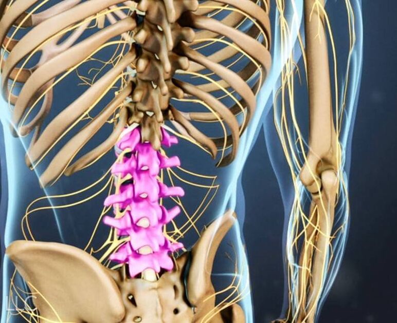 Osteocondrosis de la columna lumbar. 